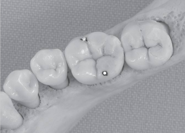 下牙槽神经麻醉的新方法！看起来挺厉害