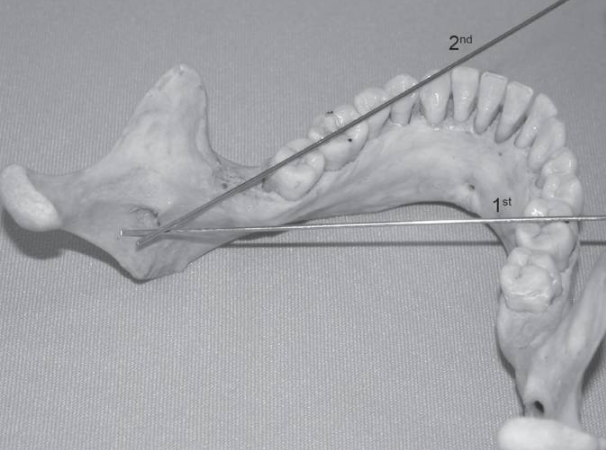 下牙槽神经麻醉的新方法！看起来挺厉害