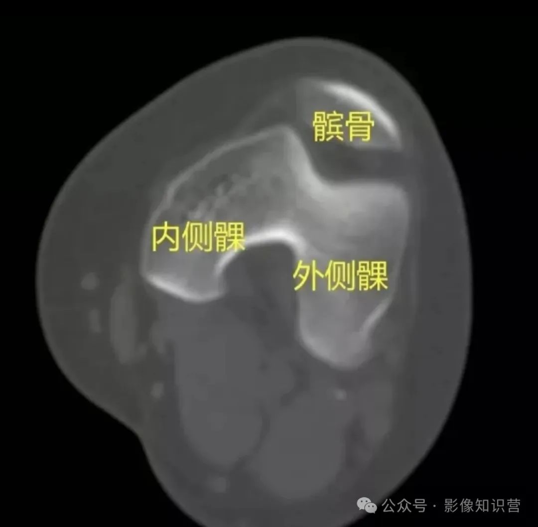 四肢骨骼影像解剖,一文掌握!