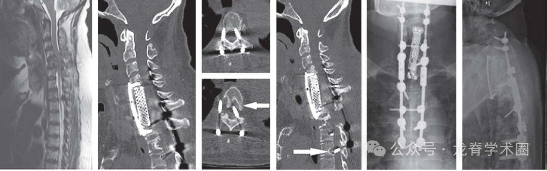 脊柱转移瘤患者术后症状性内固定失效