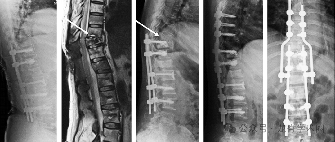 脊柱转移瘤患者术后症状性内固定失效