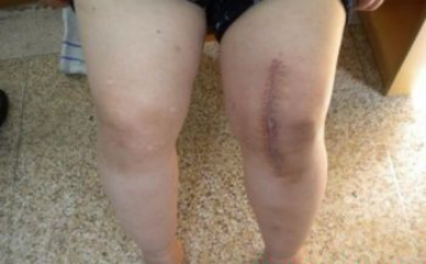 给你整理好了!人工膝关节置换手术步骤全解