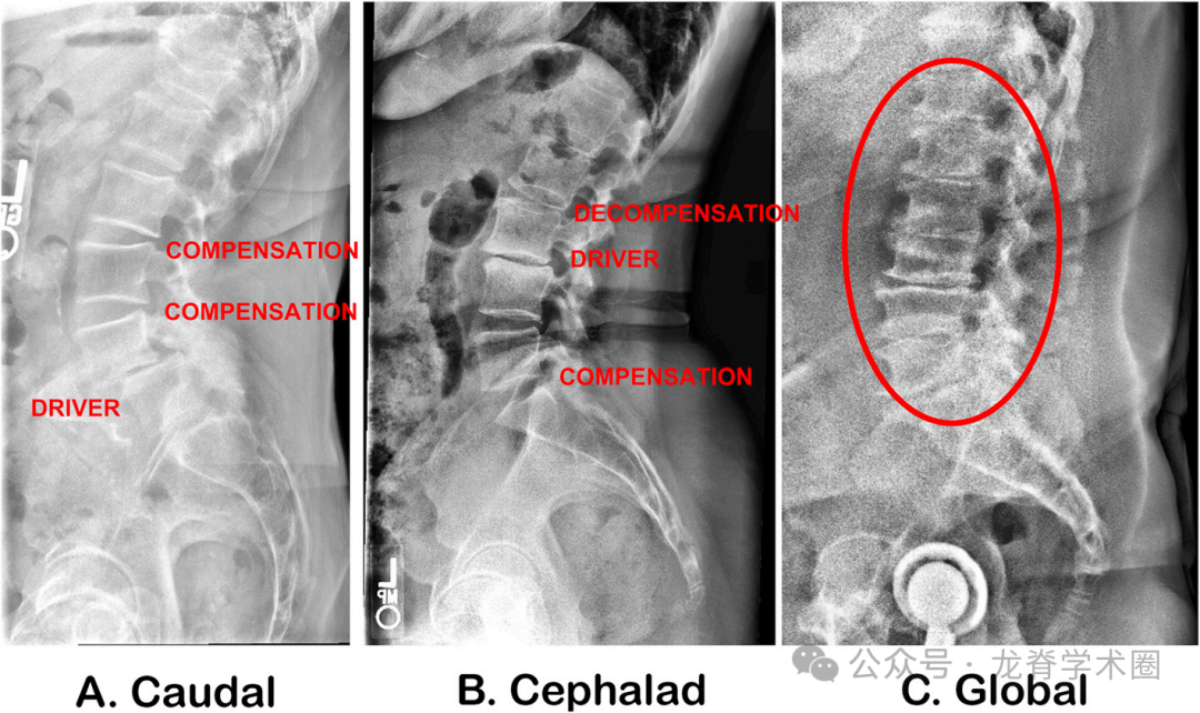 《JBJS》:腰椎退行性疾病中的矢状位平衡