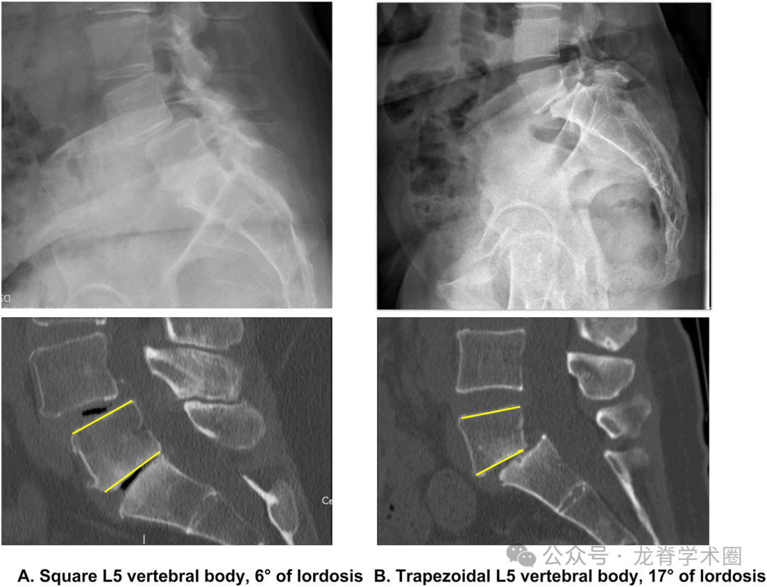 《JBJS》:腰椎退行性疾病中的矢状位平衡