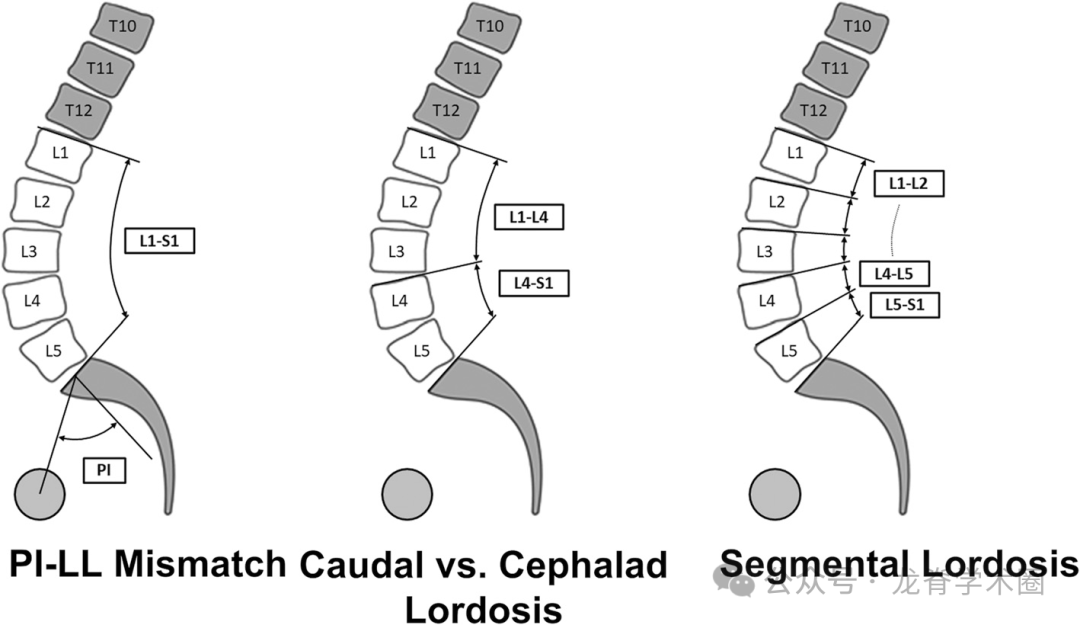 《JBJS》:腰椎退行性疾病中的矢状位平衡