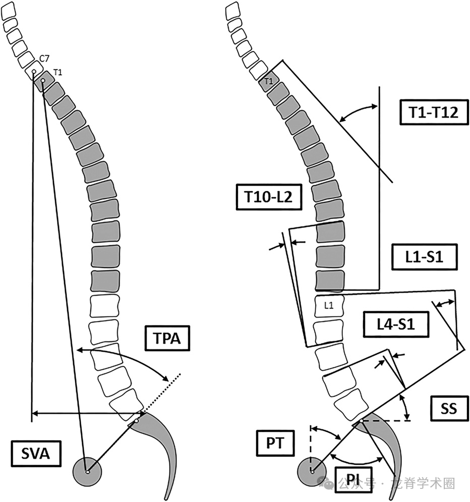 《JBJS》:腰椎退行性疾病中的矢状位平衡