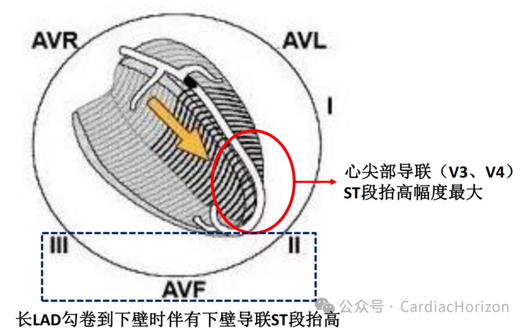 如何快速定位急性心肌梗死罪犯血管,这篇文章教会你