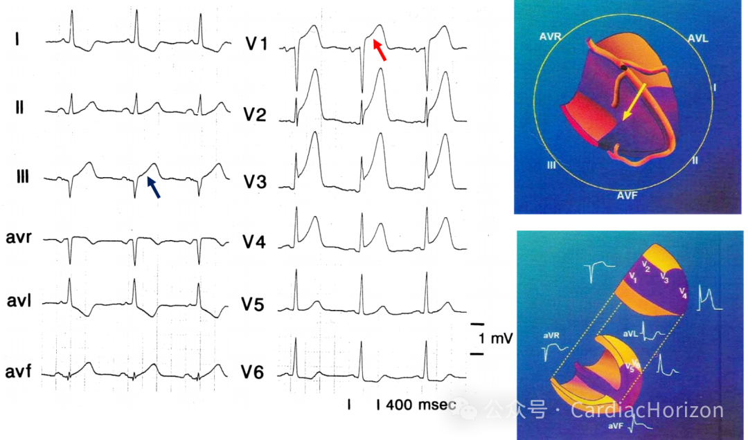 如何快速定位急性心肌梗死罪犯血管,这篇文章教会你