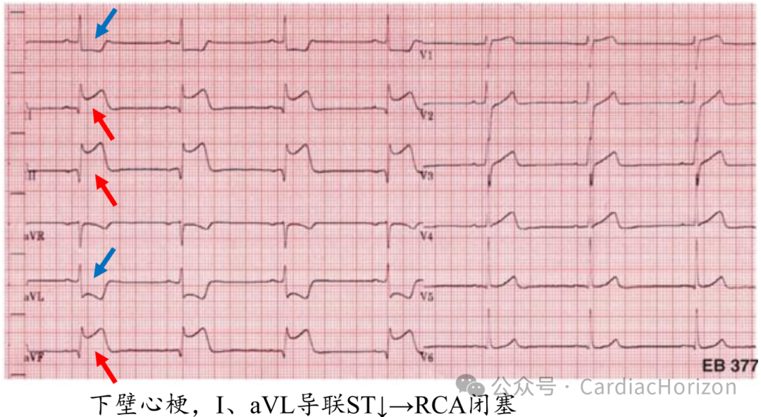 如何快速定位急性心肌梗死罪犯血管,这篇文章教会你