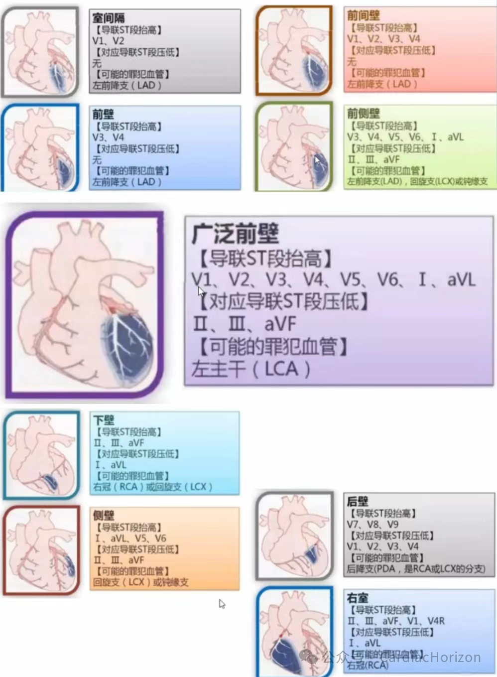 如何快速定位急性心肌梗死罪犯血管,这篇文章教会你