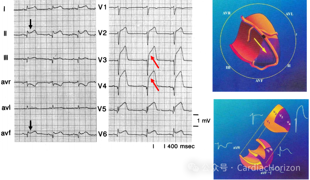 如何快速定位急性心肌梗死罪犯血管,这篇文章教会你