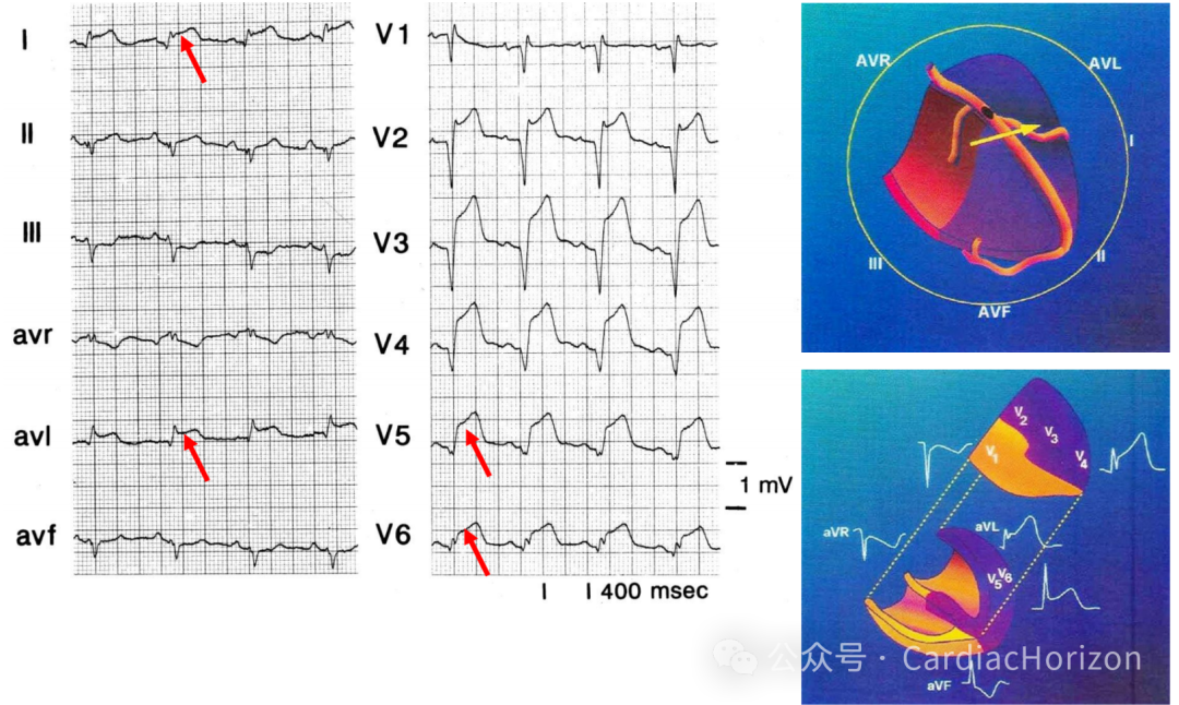 如何快速定位急性心肌梗死罪犯血管,这篇文章教会你