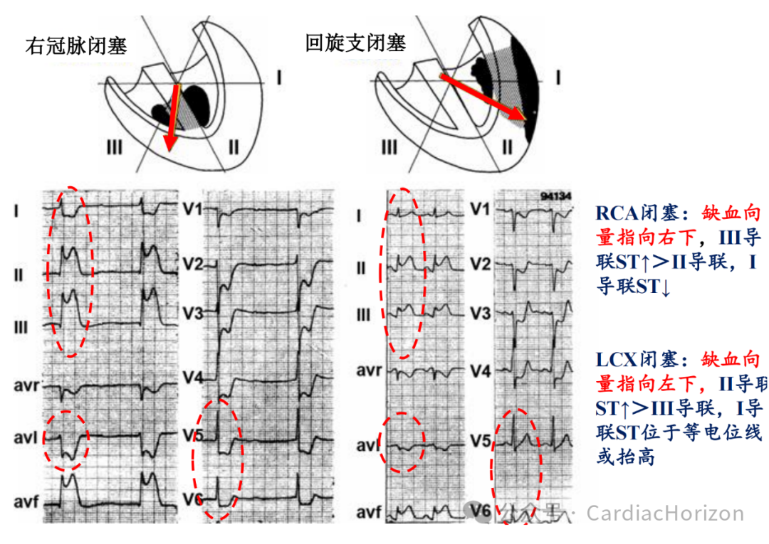 如何快速定位急性心肌梗死罪犯血管,这篇文章教会你