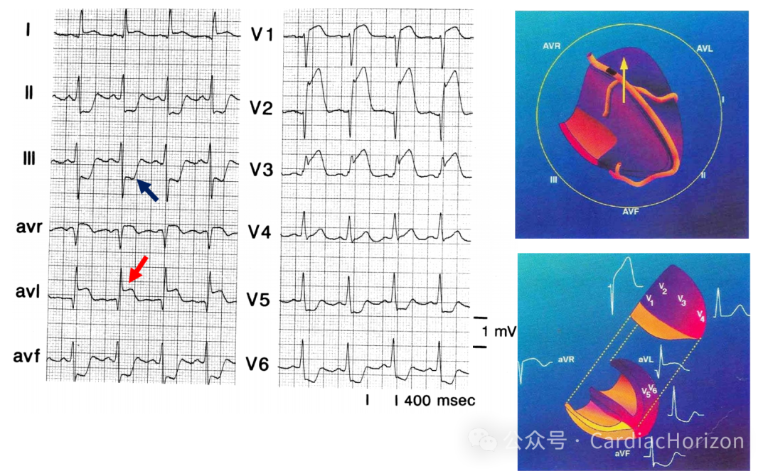 如何快速定位急性心肌梗死罪犯血管,这篇文章教会你