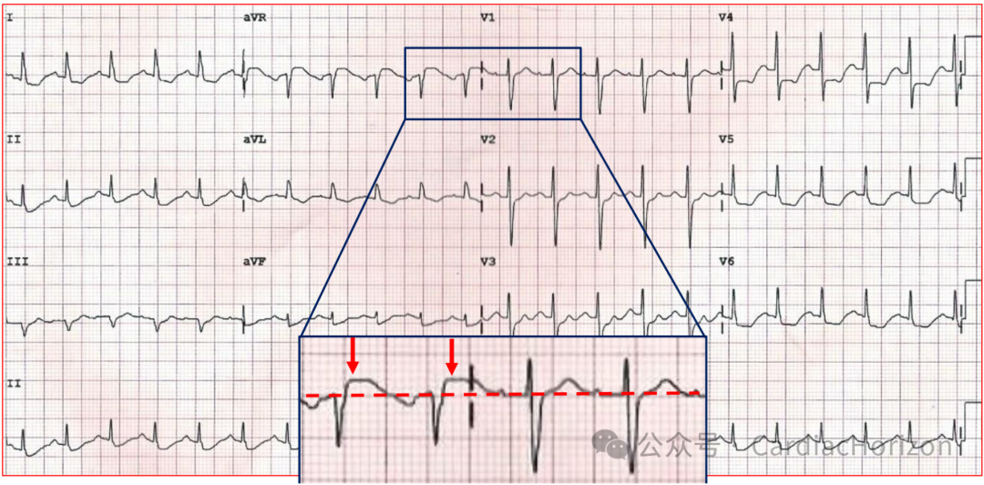 如何快速定位急性心肌梗死罪犯血管,这篇文章教会你