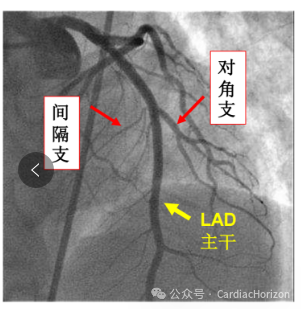 如何快速定位急性心肌梗死罪犯血管,这篇文章教会你