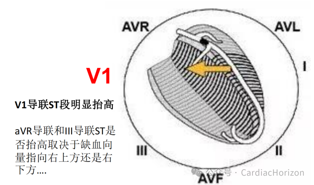 如何快速定位急性心肌梗死罪犯血管,这篇文章教会你