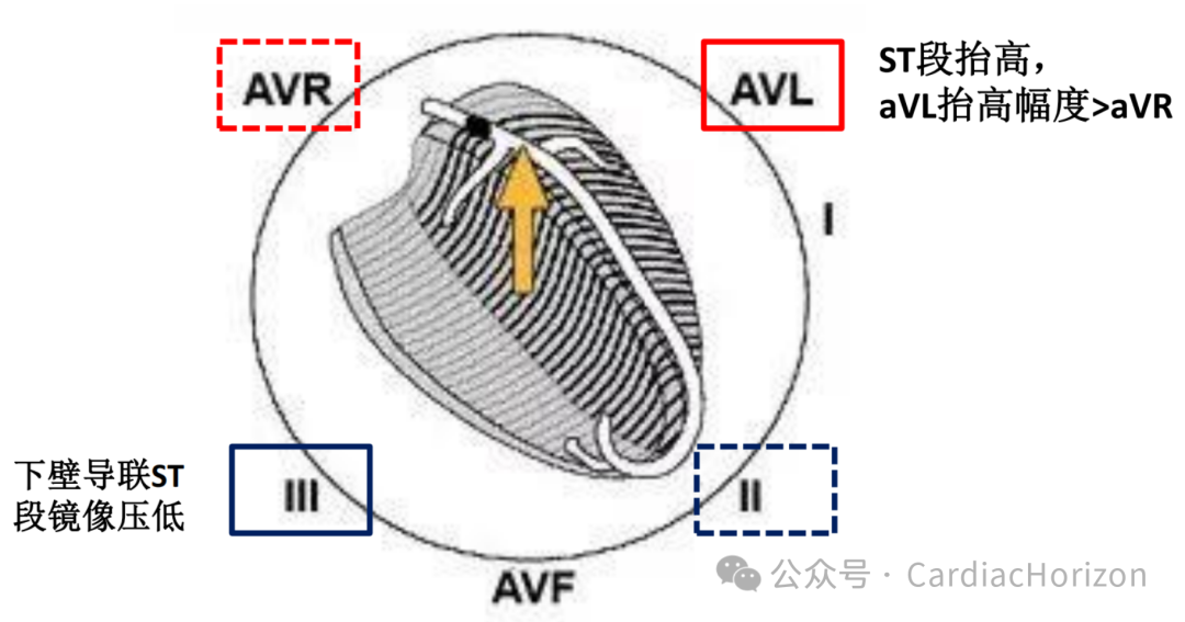 如何快速定位急性心肌梗死罪犯血管,这篇文章教会你