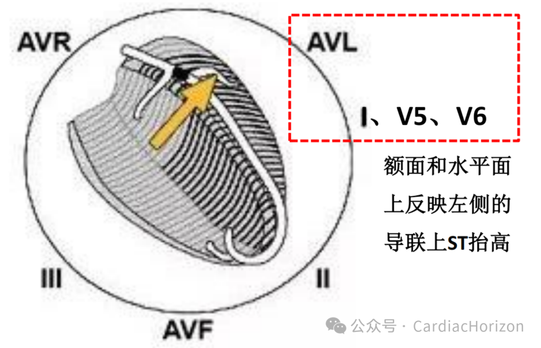 如何快速定位急性心肌梗死罪犯血管,这篇文章教会你