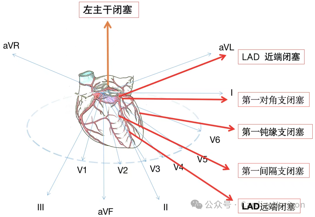 如何快速定位急性心肌梗死罪犯血管,这篇文章教会你