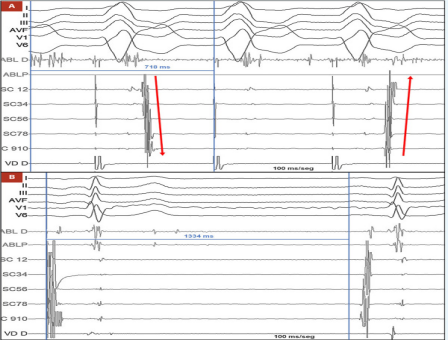 病态窦房结综合征(慢-快综合征):选择起搏器置入或消融?