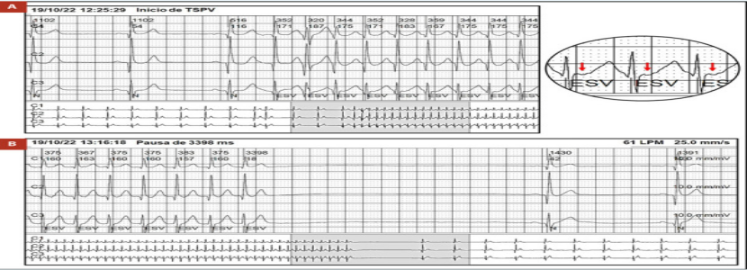 病态窦房结综合征(慢-快综合征):选择起搏器置入或消融?
