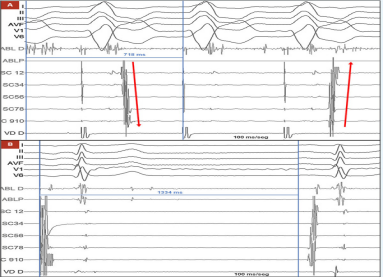 病态窦房结综合征(慢-快综合征):选择起搏器置入或消融?