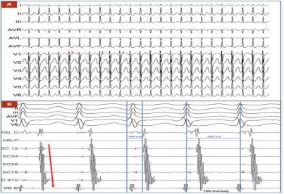 病态窦房结综合征(慢-快综合征):选择起搏器置入或消融?