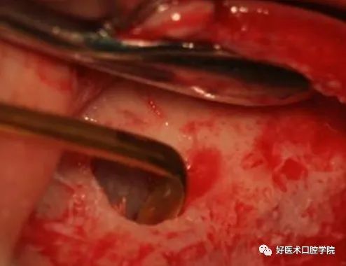 一文读懂与上颌窦提升术相关的上颌窦囊性病变!