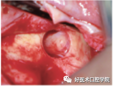 一文读懂与上颌窦提升术相关的上颌窦囊性病变!