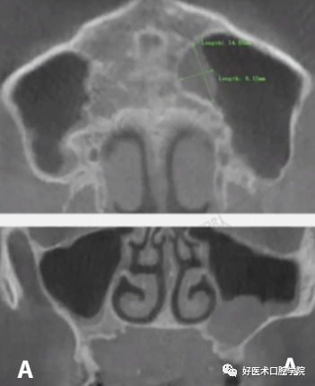 一文读懂与上颌窦提升术相关的上颌窦囊性病变!