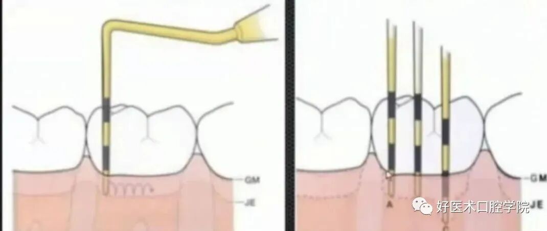 牙周刮治技术,从检查到操作方法,全套要点总结!