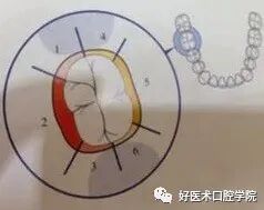 牙周刮治技术,从检查到操作方法,全套要点总结!