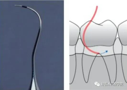 牙周刮治技术,从检查到操作方法,全套要点总结!