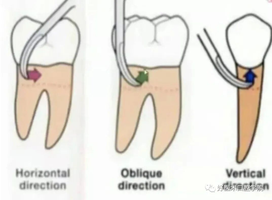 牙周刮治技术,从检查到操作方法,全套要点总结!