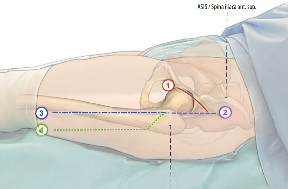 图文并茂:股骨翻修手术中的直接前入路(DAA)技术详解