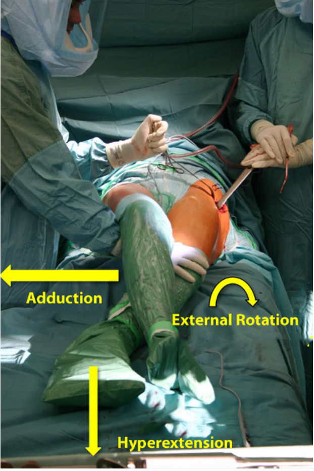 图文并茂:股骨翻修手术中的直接前入路(DAA)技术详解