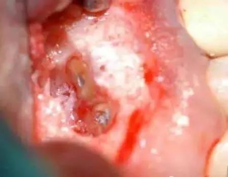 高清图文:根尖切除术操作全过程