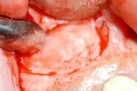 高清图文:根尖切除术操作全过程