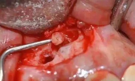 高清图文:根尖切除术操作全过程