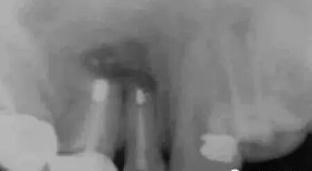 高清图文:根尖切除术操作全过程