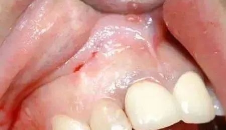 高清图文:根尖切除术操作全过程