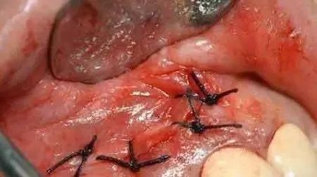 高清图文:根尖切除术操作全过程