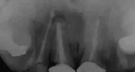 高清图文:根尖切除术操作全过程