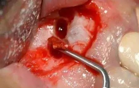 高清图文:根尖切除术操作全过程