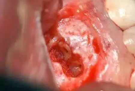 高清图文:根尖切除术操作全过程