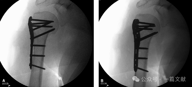肱骨近端骨折术中透视技巧