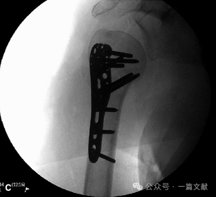 肱骨近端骨折术中透视技巧