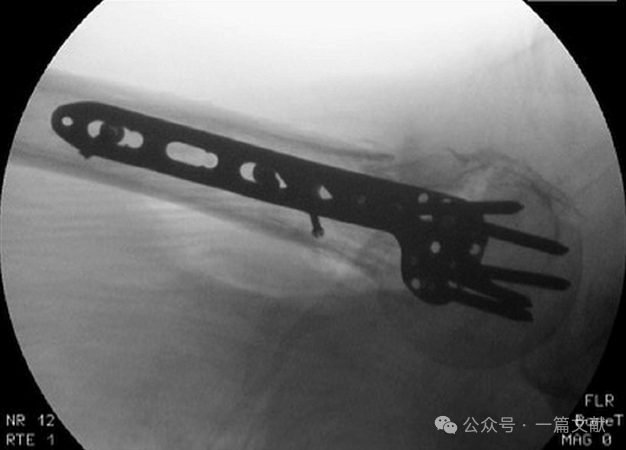 肱骨近端骨折术中透视技巧