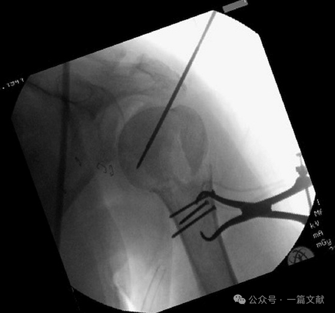 肱骨近端骨折术中透视技巧